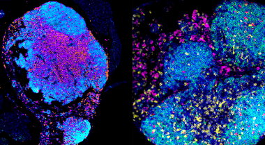 Rewiring Immune System Offers New Path to Better Ovarian Cancer Treatment