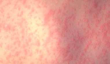 Virginia health officials investigate potential measles exposure in Lynchburg