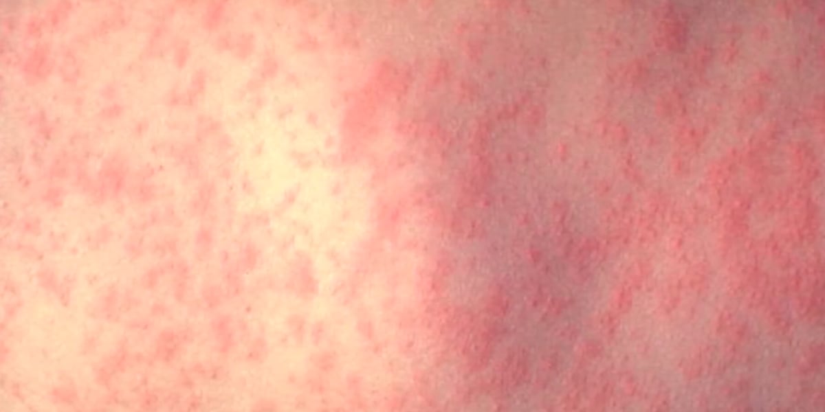 Virginia health officials investigate potential measles exposure in Lynchburg