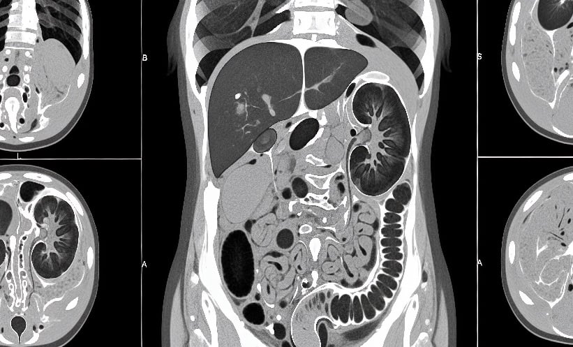Rising CT Scans in Elderly Raise Radiation Questions – EMJ