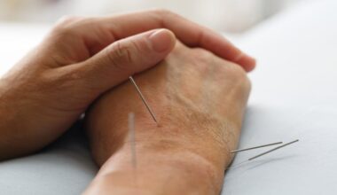 Close-up of acupuncture needles inserted into the hands during a manual acupuncture treatment session.