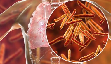 Tuberculosis cases remain high but ‘levelling off’, HSE says – The Irish Times