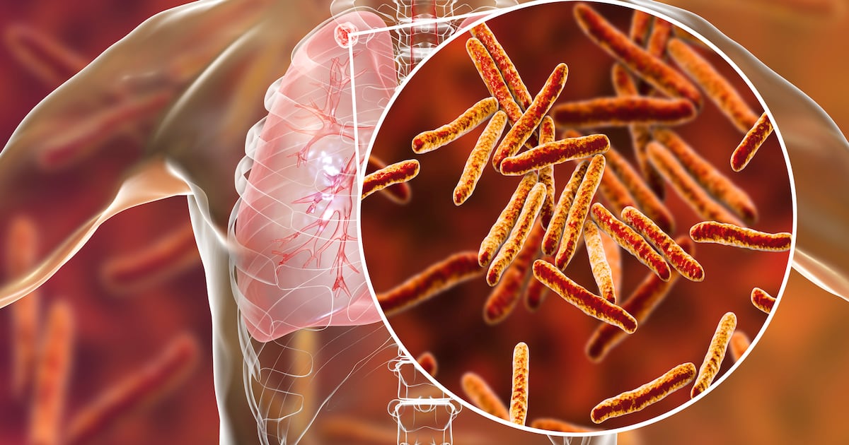 Tuberculosis cases remain high but ‘levelling off’, HSE says – The Irish Times