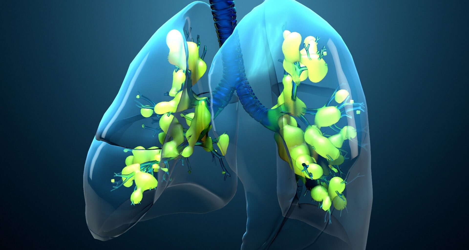 Study: Four year mortality and quality of life after ICU treatment for COVID 19 related acute respiratory distress syndrome. Image Credit: Design_Cells / Shutterstock