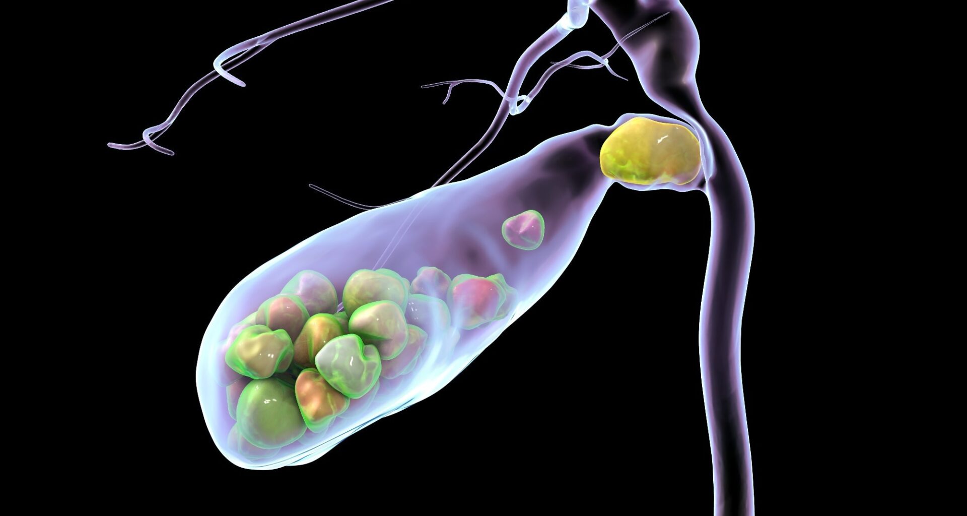 Study: Association between total dietary sugar intake and gallstones in Americans. Image Credit: Kateryna Kon / Shutterstock