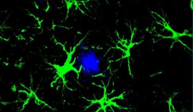 As VA Looks Ahead to Dementia Needs, Study Finds Immune Cells Attack Alzheimer’s Plaques in Brain