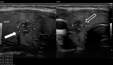 Papillary Thyroid Carcinoma in a Pediatric Patient With Graves’ Disease: A Case Report and Literature Review