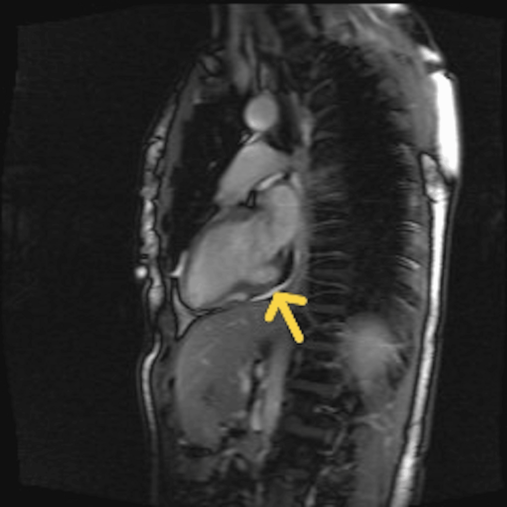 A Benign Outpouching Masquerading as a Scar: A Case of an Incidentally Diagnosed Cardiac Diverticulum