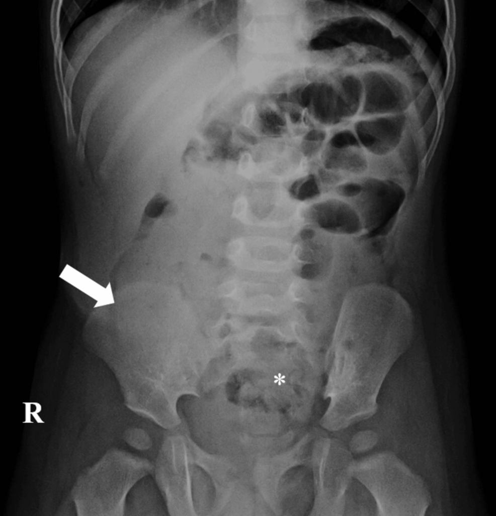 Navigating the Diagnostic Dilemma: Cecal Duplication Cyst and Intussusception in Pediatric Patients