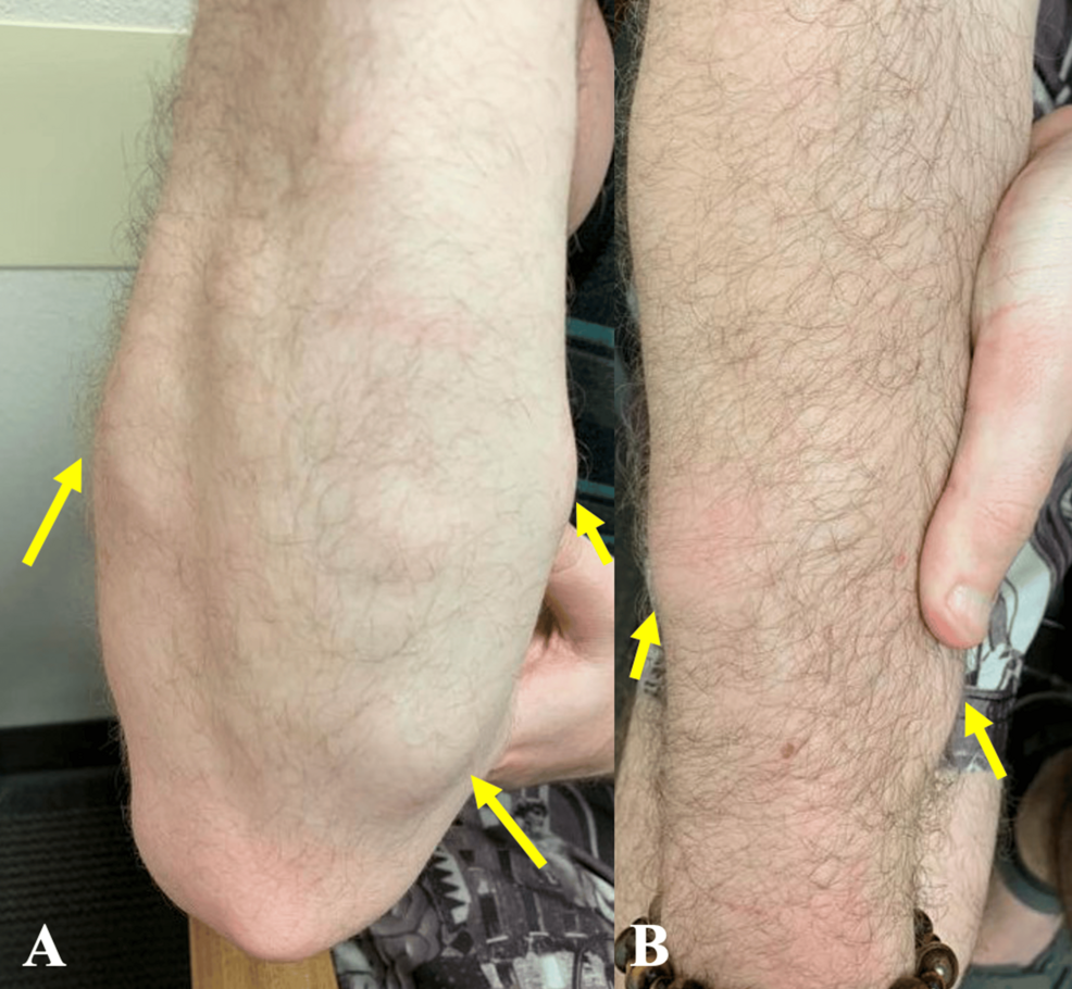 Angiolipomatous Atypical Presentation of Dercum’s Disease