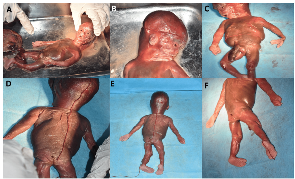 Spectrum of Chromosomal Abnormalities in Abortus and Medically Terminated Fetal Samples From a Tertiary Care Center in the Sub-Himalayan Region of North India