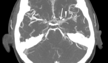 Recurrent Ischemic Events in Adult Moyamoya Disease: A Case Report of Persistent Symptoms Despite Encephaloduroarteriosynangiosis (EDAS) Surgery