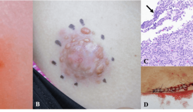 Cutaneous Rosai-Dorfman Disease Misdiagnosed as Granulomatous Dermatitis: A Diagnostic Pitfall