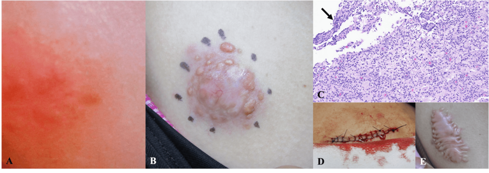 Cutaneous Rosai-Dorfman Disease Misdiagnosed as Granulomatous Dermatitis: A Diagnostic Pitfall