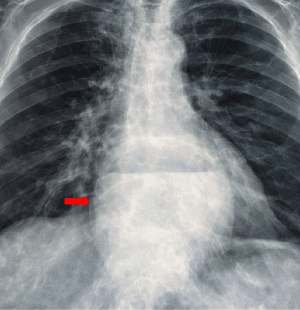 The Wandering Pancreas: A Rare Case of Complex Hiatal Hernia Presenting With Thoracic Symptoms