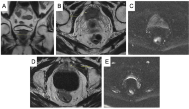 Diagnosis and Management of Synchronous Prostate and Rectal Cancer in a Patient