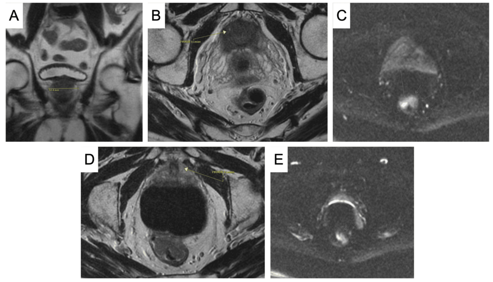 Diagnosis and Management of Synchronous Prostate and Rectal Cancer in a Patient