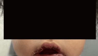 Kawasaki Disease Recurrence as a Diagnostic and Therapeutic Challenge: A Case Report