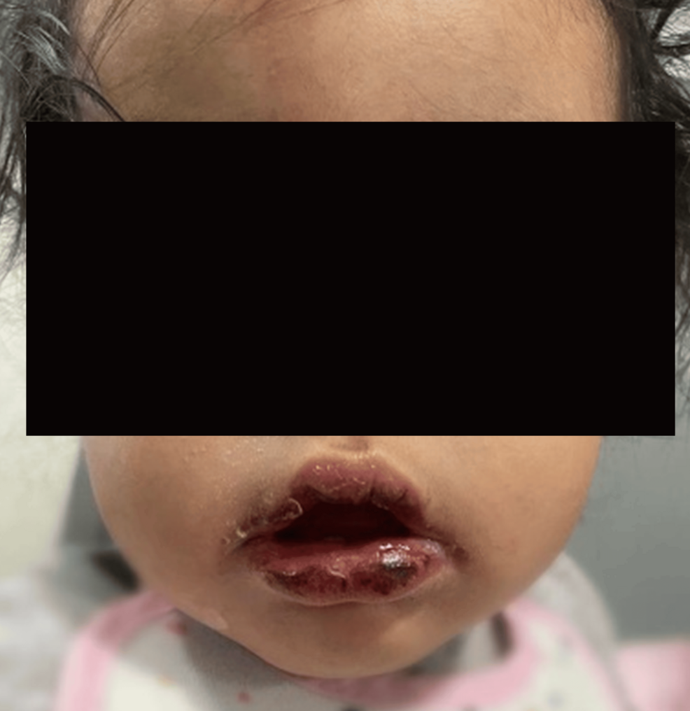 Kawasaki Disease Recurrence as a Diagnostic and Therapeutic Challenge: A Case Report
