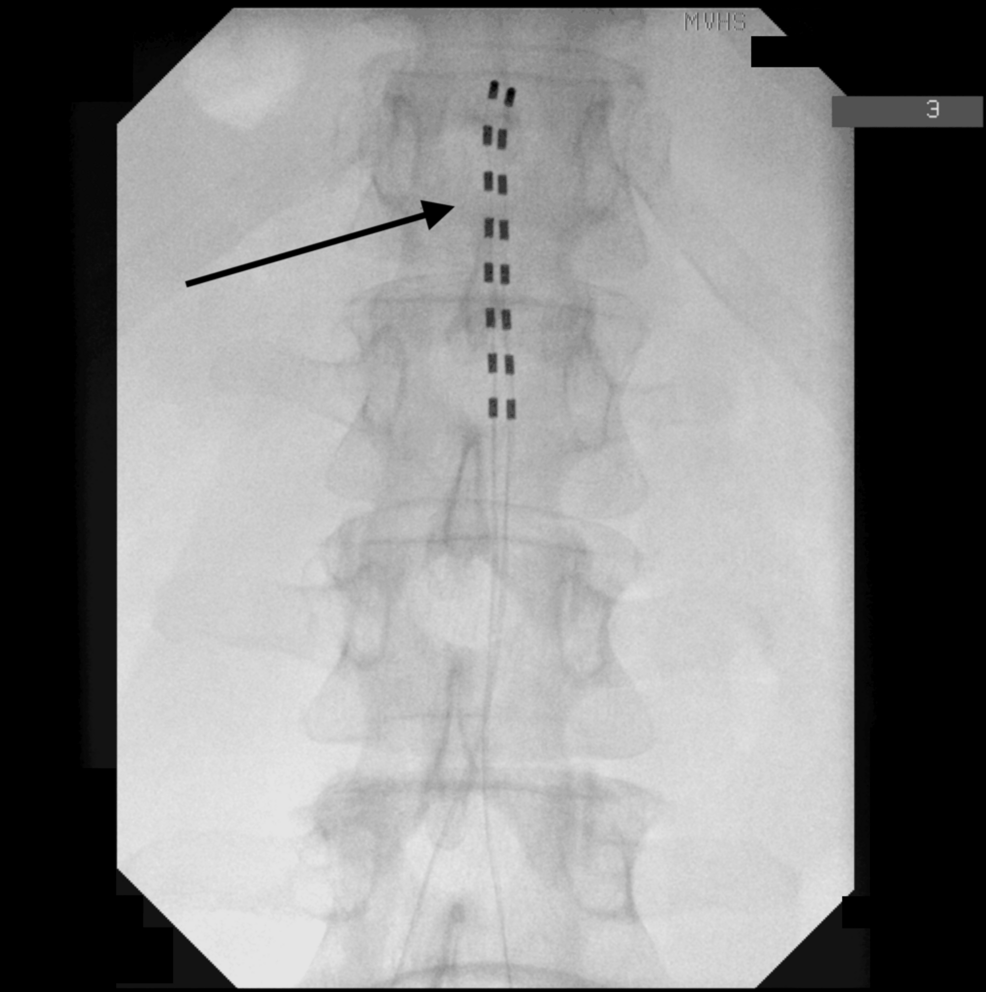Spinal Cord Stimulation for Chronic Pelvic Pain Secondary to Oncologic Complications: A Case Report