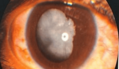 Viscosynechiolysis and Aspiration-Based Management in Uveitic Cataract Surgery: A Case Report