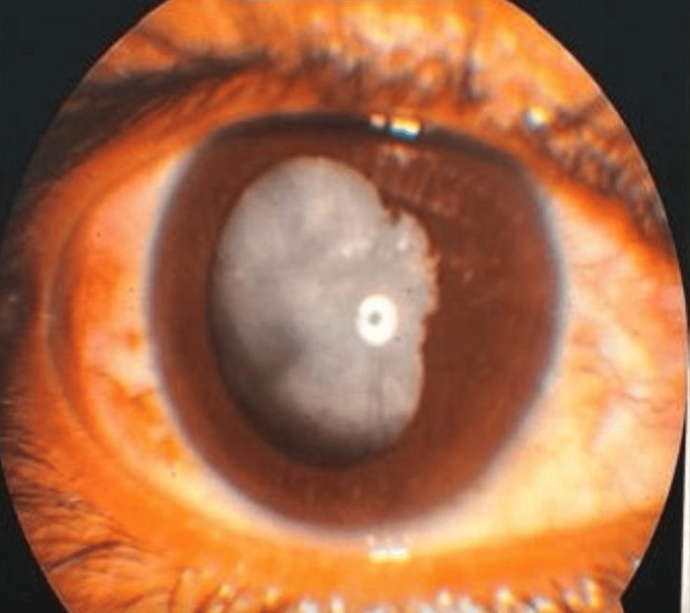 Viscosynechiolysis and Aspiration-Based Management in Uveitic Cataract Surgery: A Case Report