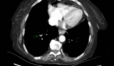 Massive Bilateral Pulmonary Embolism Presenting as Isolated Abdominal Pain: An Atypical Presentation and Incidental Detection in Dual Immune-Mediated Disease