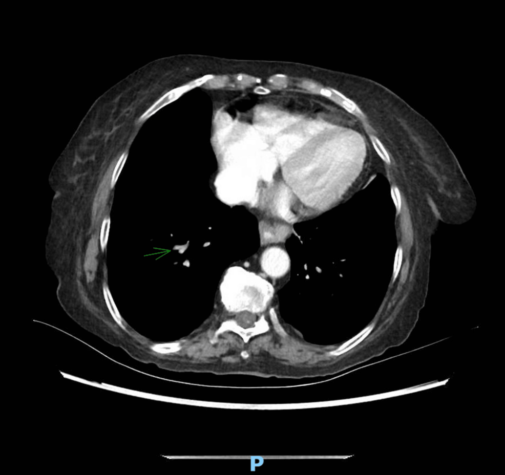 Massive Bilateral Pulmonary Embolism Presenting as Isolated Abdominal Pain: An Atypical Presentation and Incidental Detection in Dual Immune-Mediated Disease