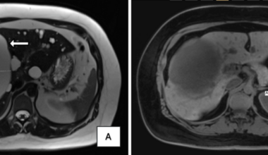 Clinical and Genetic Characterization of a Patient With SEC63-Related Autosomal Dominant Polycystic Liver Disease and an IFT140 Pathogenic Variant Associated With Polycystic Kidney Disease