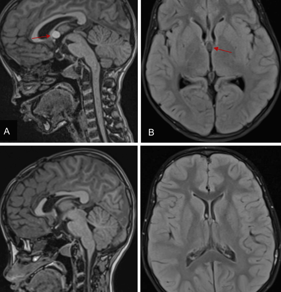 Incidentally Detected Colloid Cyst in a Pediatric Patient With Facio-Audio-Symphalangism Syndrome: A Case Report