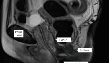 A Case of Urethral Carcinoma With Cardiac Metastasis and Pulmonary Tumor Thrombotic Microangiopathy Confirmed by Autopsy
