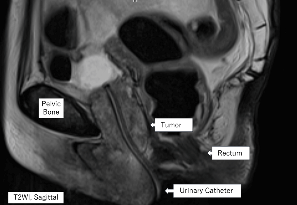 A Case of Urethral Carcinoma With Cardiac Metastasis and Pulmonary Tumor Thrombotic Microangiopathy Confirmed by Autopsy