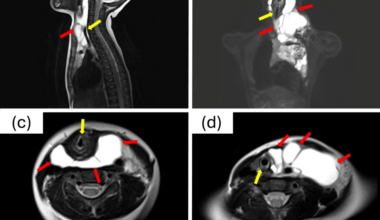 Sevoflurane Sedation for High-Risk Airway Management in the Pediatric Intensive Care Unit Following Sclerotherapy for a Pediatric Cervical Lymphatic Malformation: A Case Report