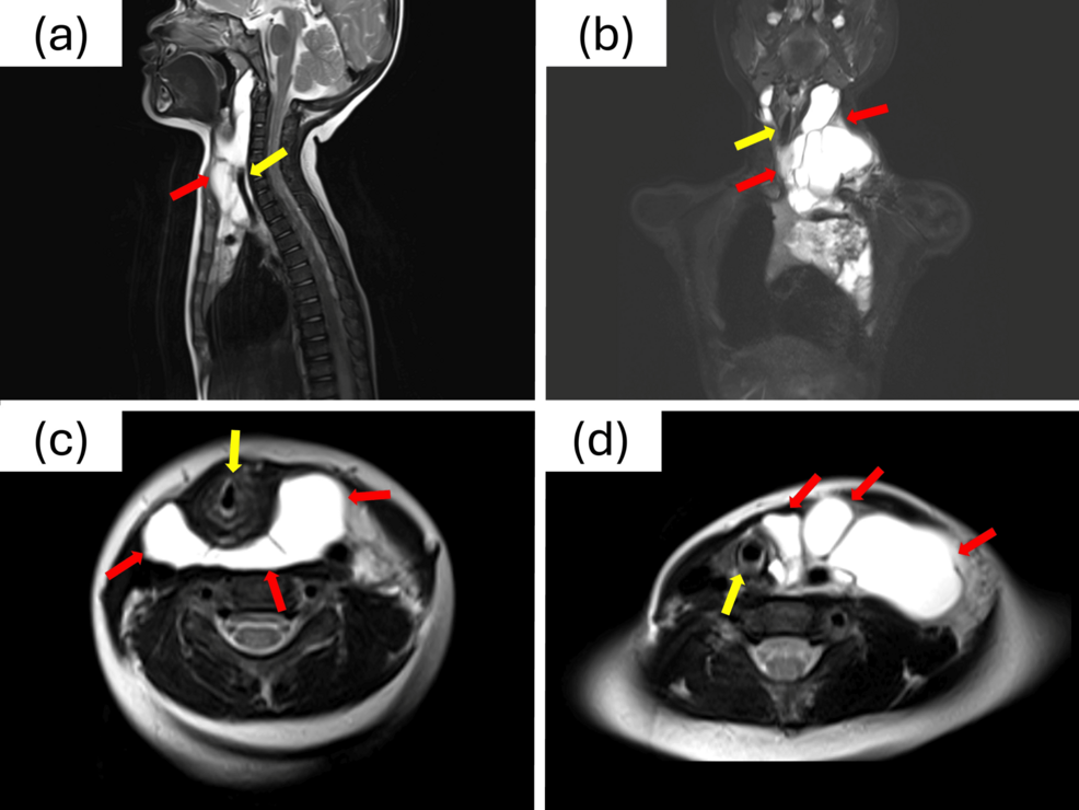 Sevoflurane Sedation for High-Risk Airway Management in the Pediatric Intensive Care Unit Following Sclerotherapy for a Pediatric Cervical Lymphatic Malformation: A Case Report