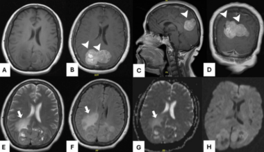 Solitary Fibrous Tumors of the Central Nervous System: A Retrospective Study From a National Referral Hospital in Mexico