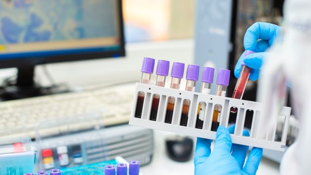 Blood Lactate Is a Key Biomarker for ALS Prognosis