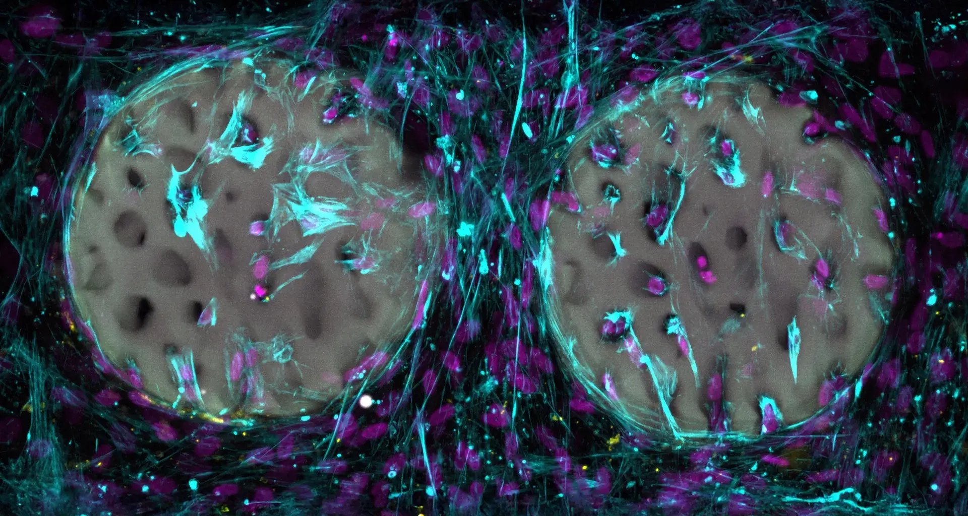 Laser printed hydrogel implant could transform bone repair