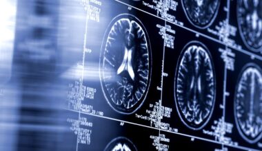 AI-driven stroke tool shows improved outcomes in major clinical trial
