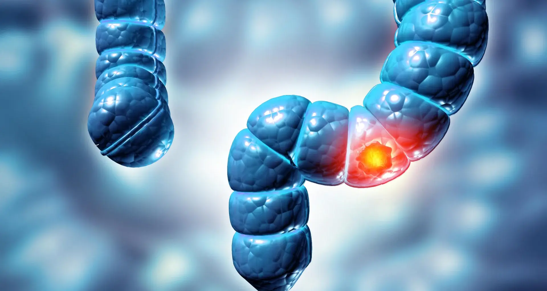 Study finds two types of colon polyps can raise bowel cancer risk fivefold