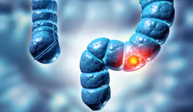 Study finds two types of colon polyps can raise bowel cancer risk fivefold