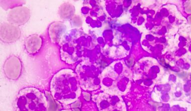 Why sepsis is becoming harder to treat in Europe