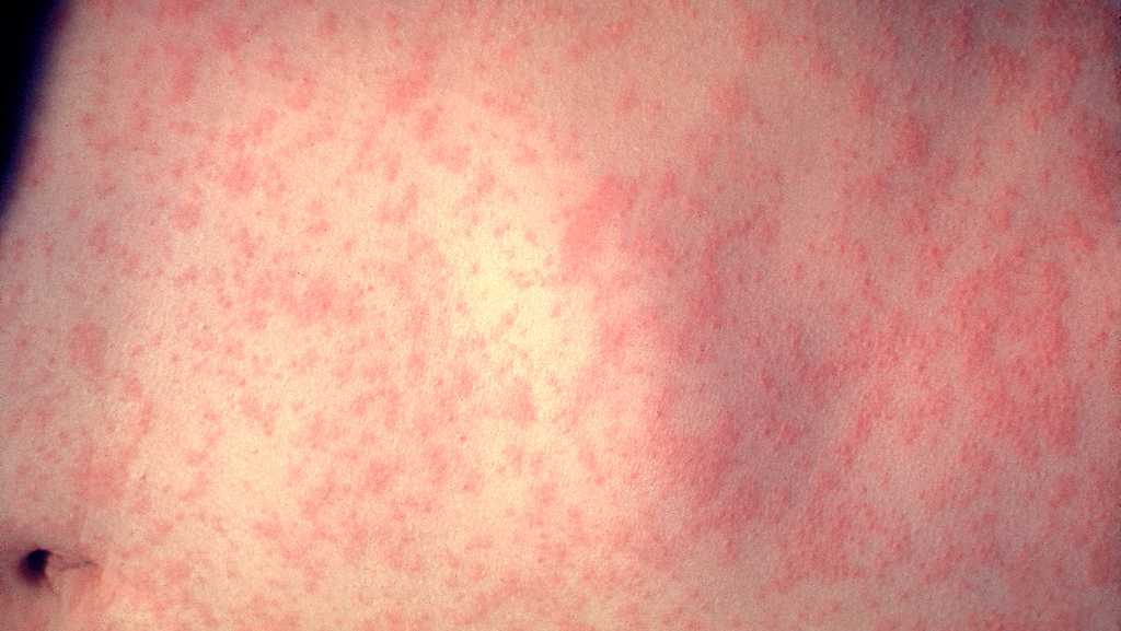 Kansas City health officials confirm first measles case in eight years