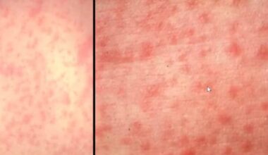 Hong Kong reports first locally acquired measles case of the year