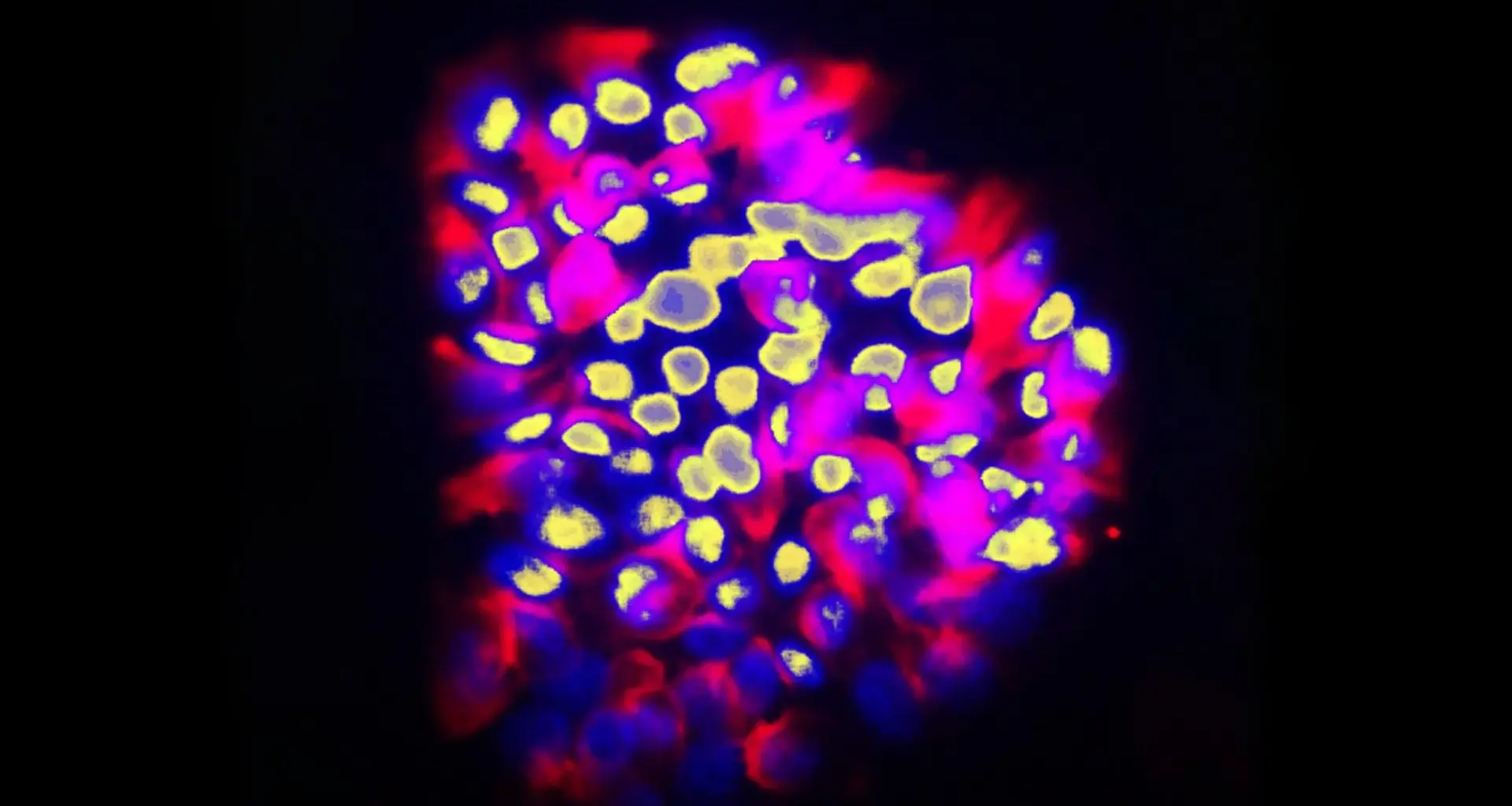 New AI tool predicts cancer spread with surprising accuracy