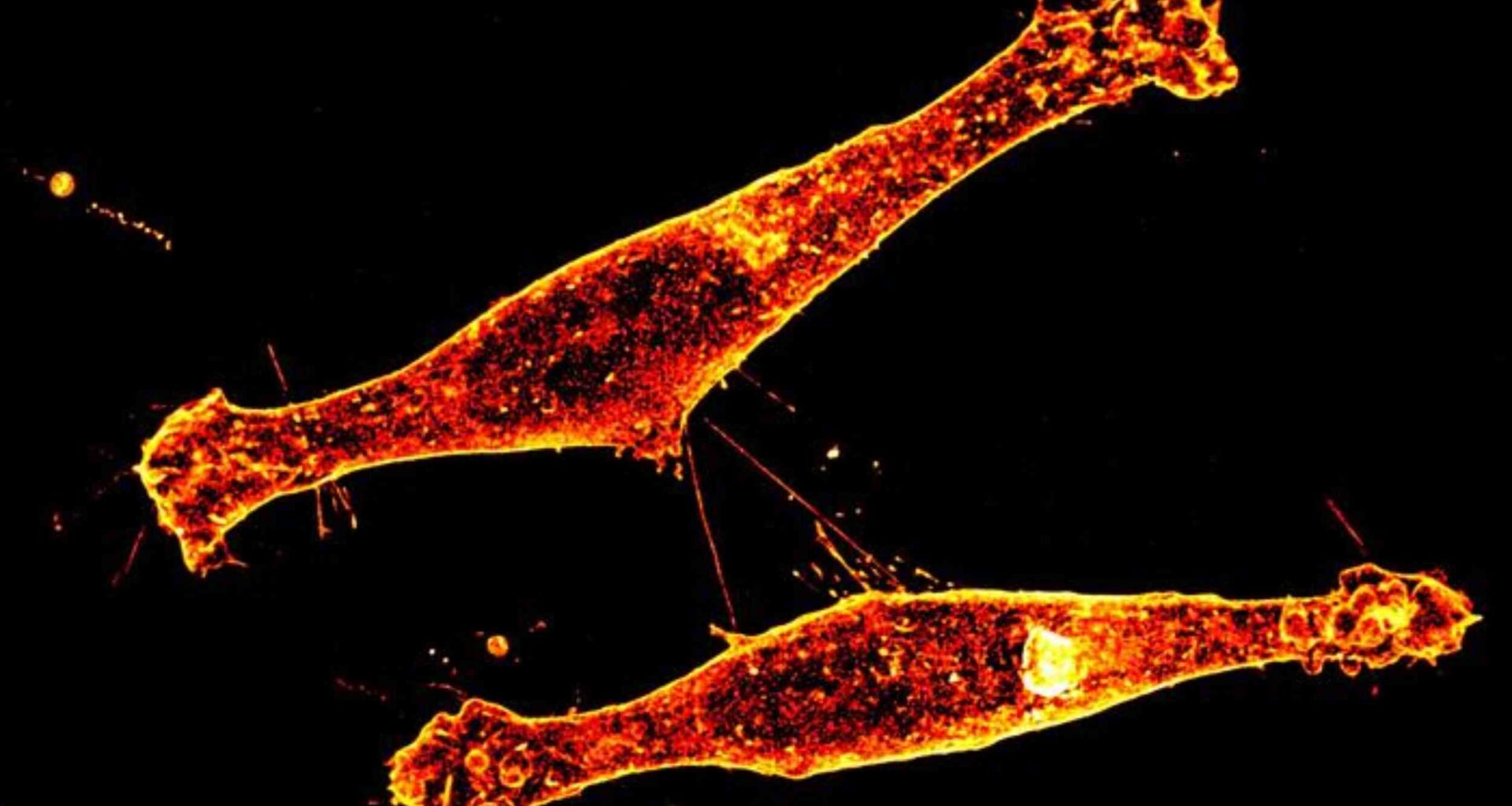 New method slows Huntington's disease by targeting neuron paths