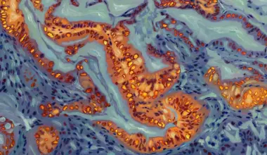 Scientists find the genetic switch that makes pancreatic cancer resist chemotherapy