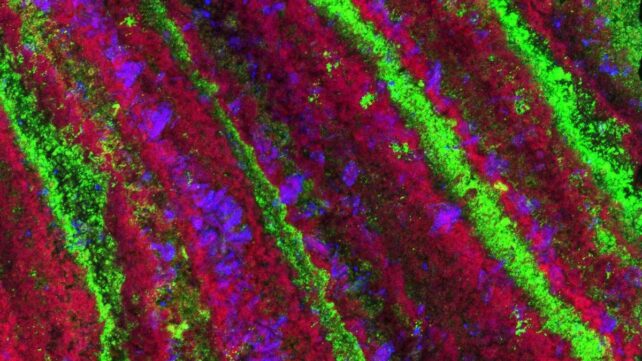 calcium-based kidney stone