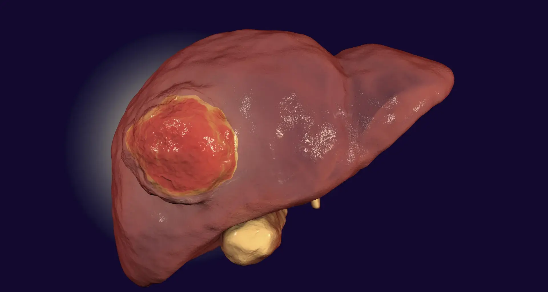 Eating less protein may slow liver cancer growth, study finds