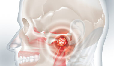 Metabolic Subtypes of Nasopharyngeal Carcinoma and Response to Treatment