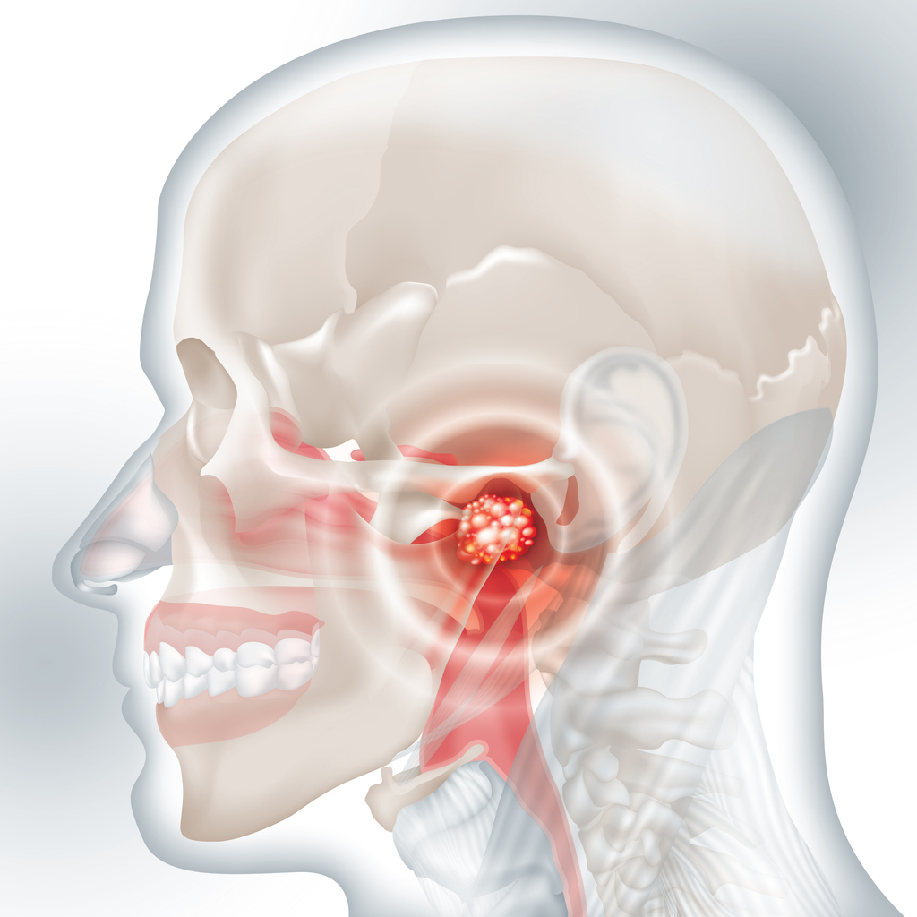 Metabolic Subtypes of Nasopharyngeal Carcinoma and Response to Treatment